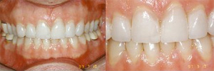 A nice white smile after veneers
