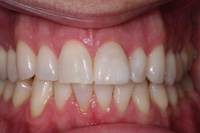 A brand new smile with just one porcelain veneer.