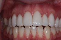 New smile with gum treatment and 10 veneers