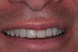 After 4 veneers and a gum treatment