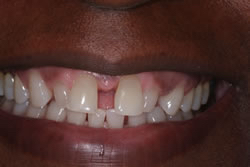 Front teeth before gum treatment and veneers