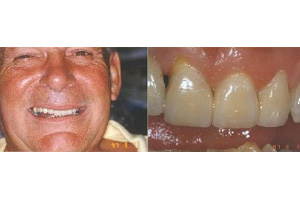 Bobby Cox after - an all new smile!