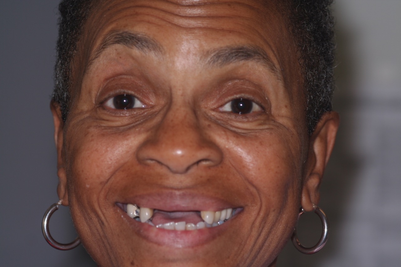Patient needs dental implants to restore a smile!