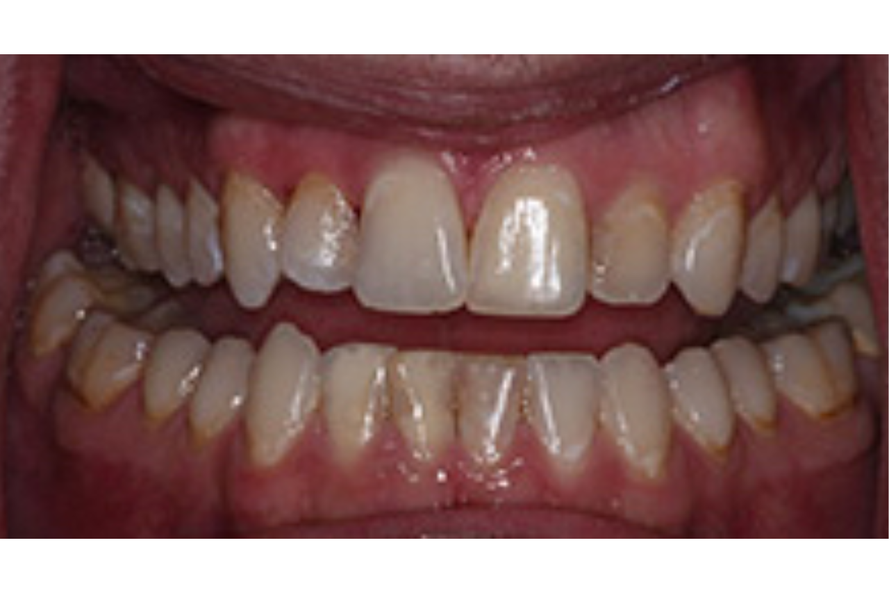 6 Veneers and a New Smile