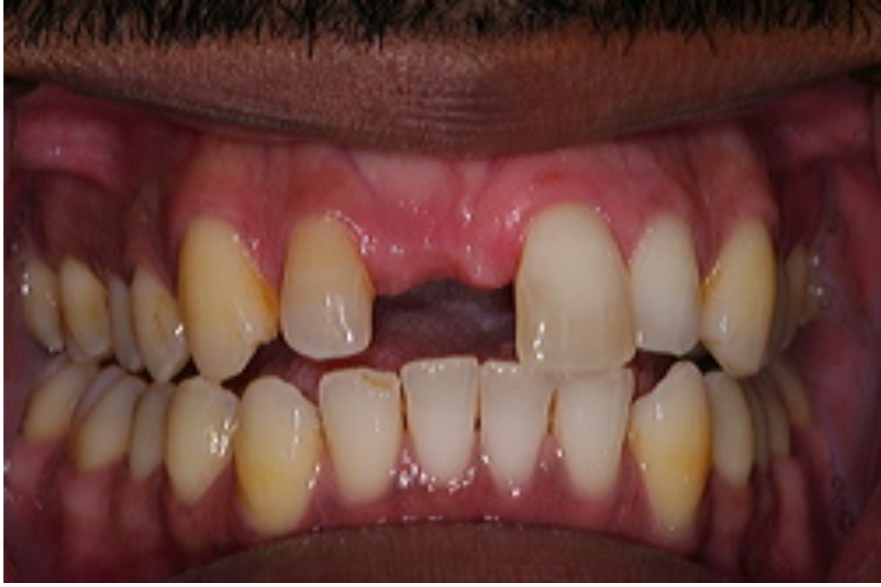 Dental Implant Helps Restore a Smile 3