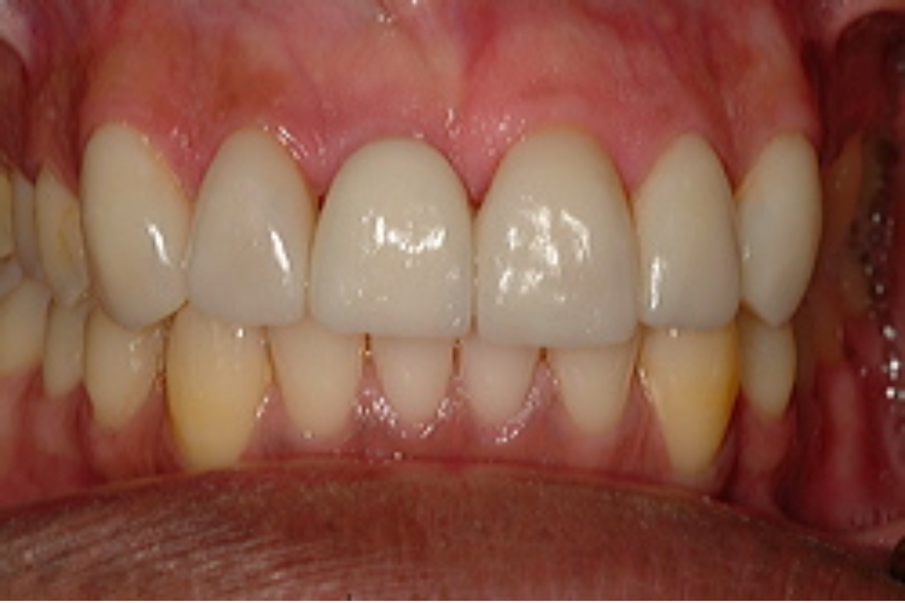 Dental Implant Helps Restore a Smile 4 1