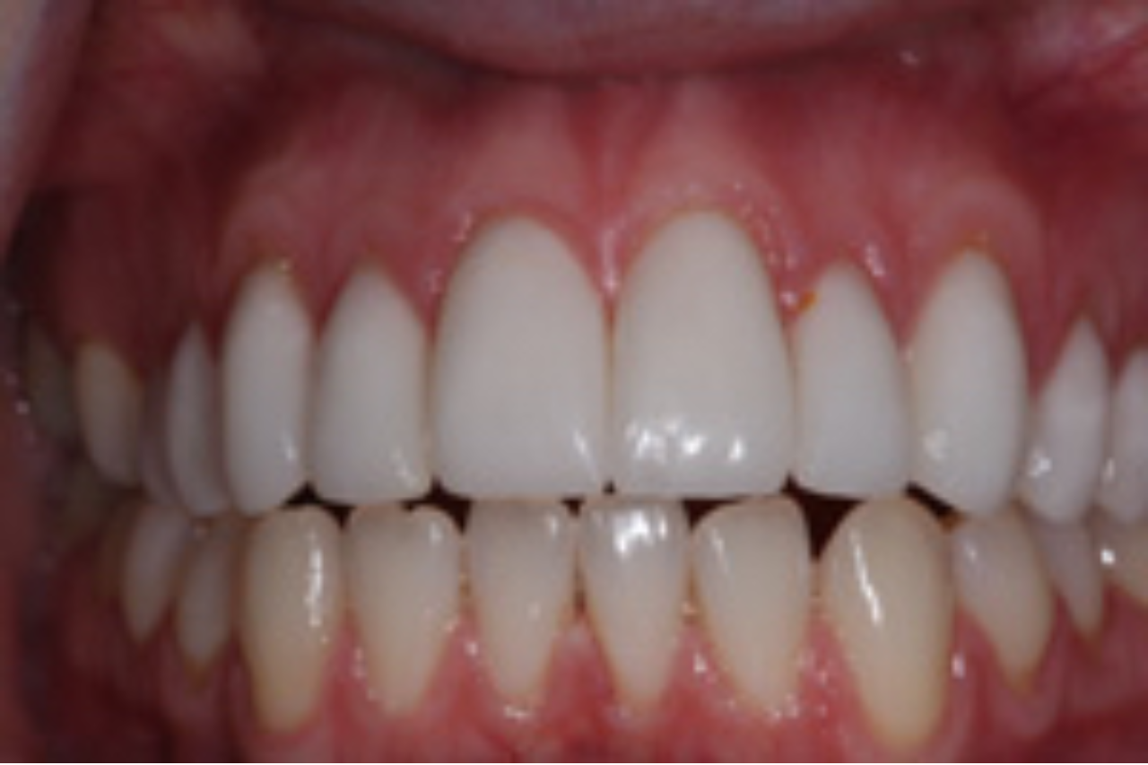 Tooth Size Corrected With Gum Treatment and 10 Veneers 1