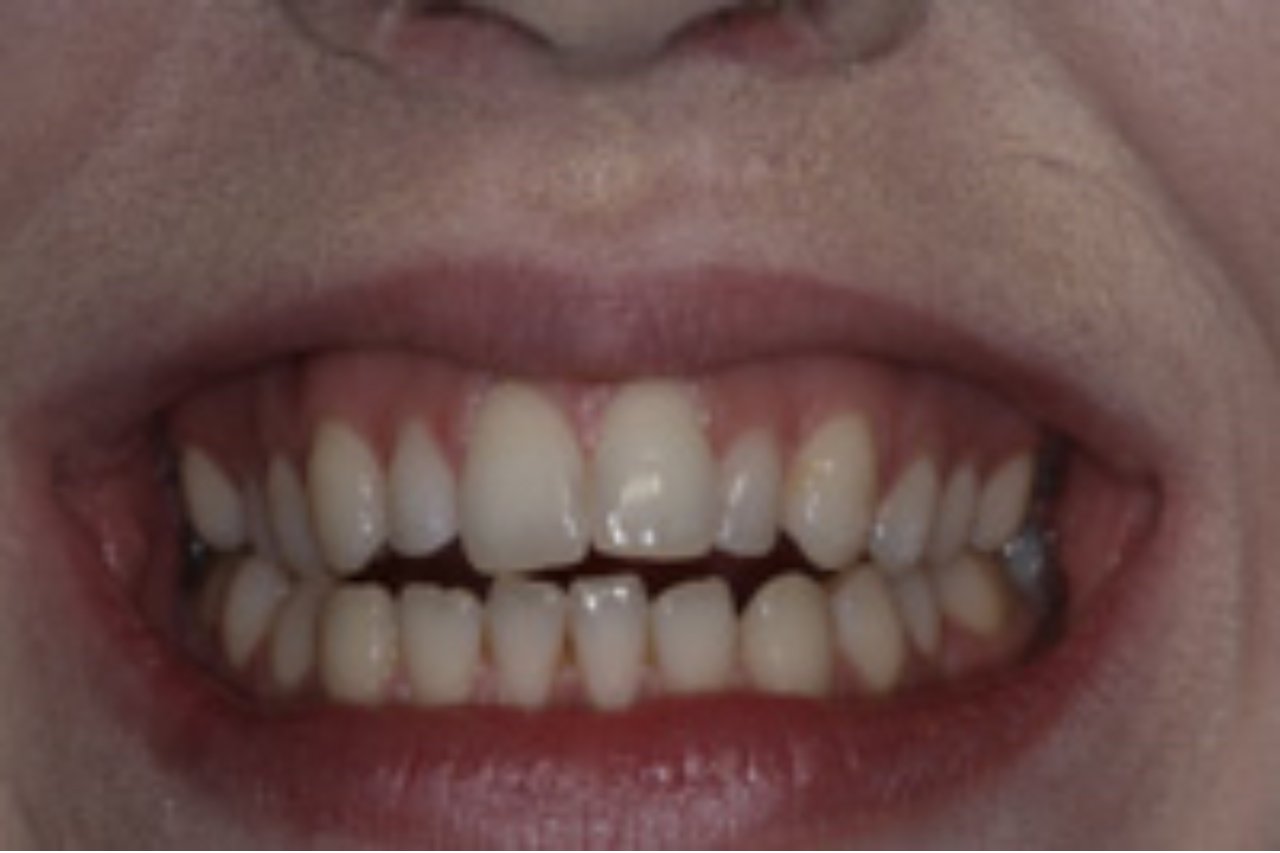 Tooth Size Corrected With Gum Treatment and 10 Veneers 2