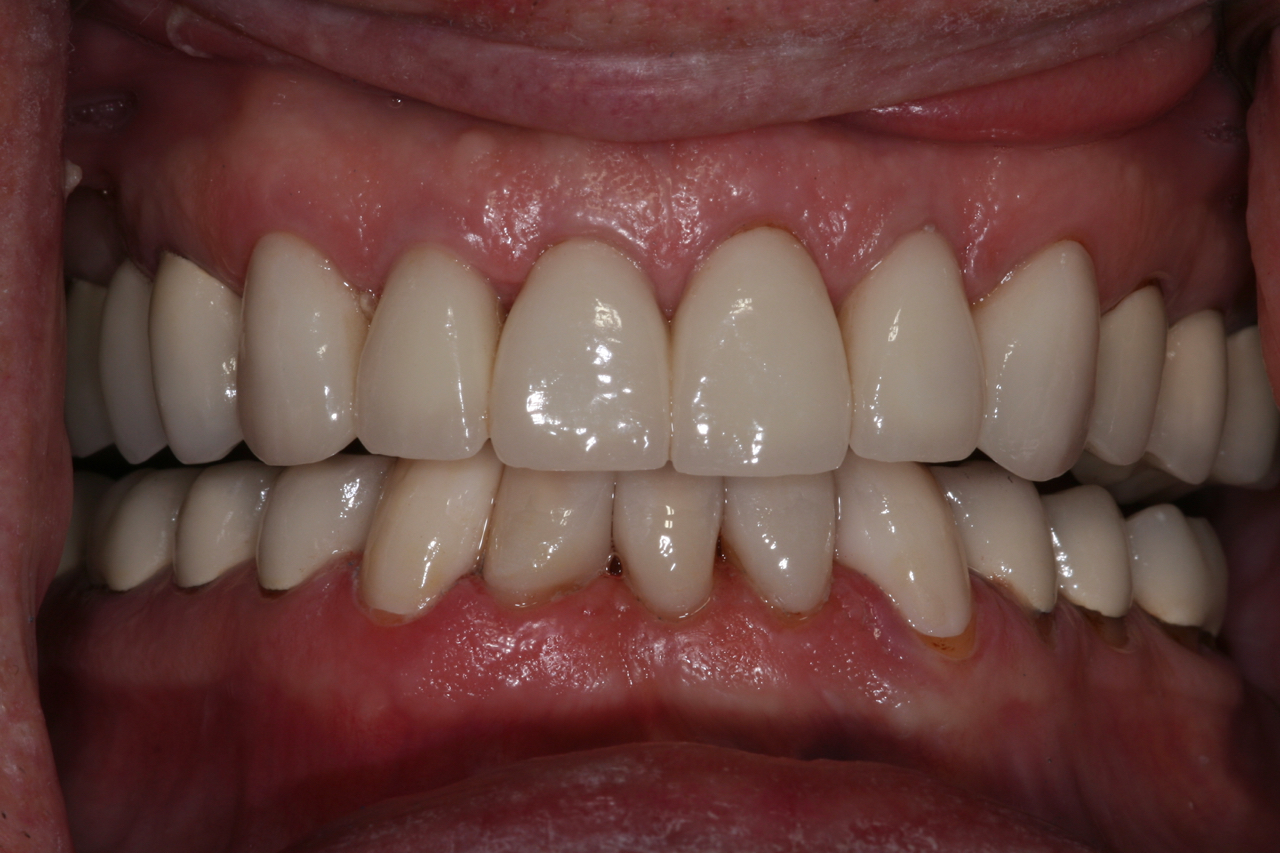 Total Smile Restoration With Crowns and Porcelain Veneers 2 1