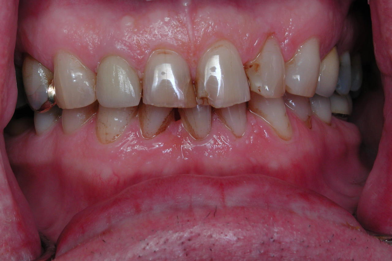Total Smile Restoration With Crowns and Porcelain Veneers