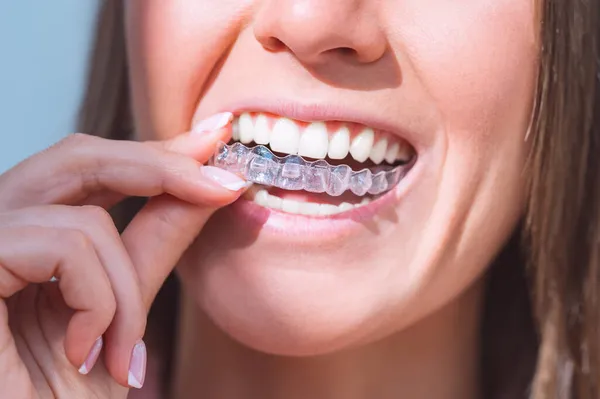 How Long Does Invisalign Take to Work