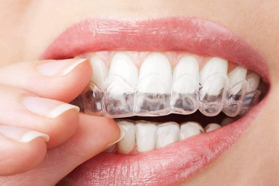 invisalign 3