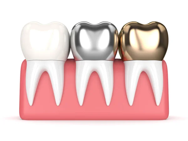 Discover the Lifespan of Dental Crowns in Atlanta GA and Essential Care Tips for Longevity 10 Discover the Lifespan of Dental Crowns in Atlanta GA and Essential Care Tips for Longevity