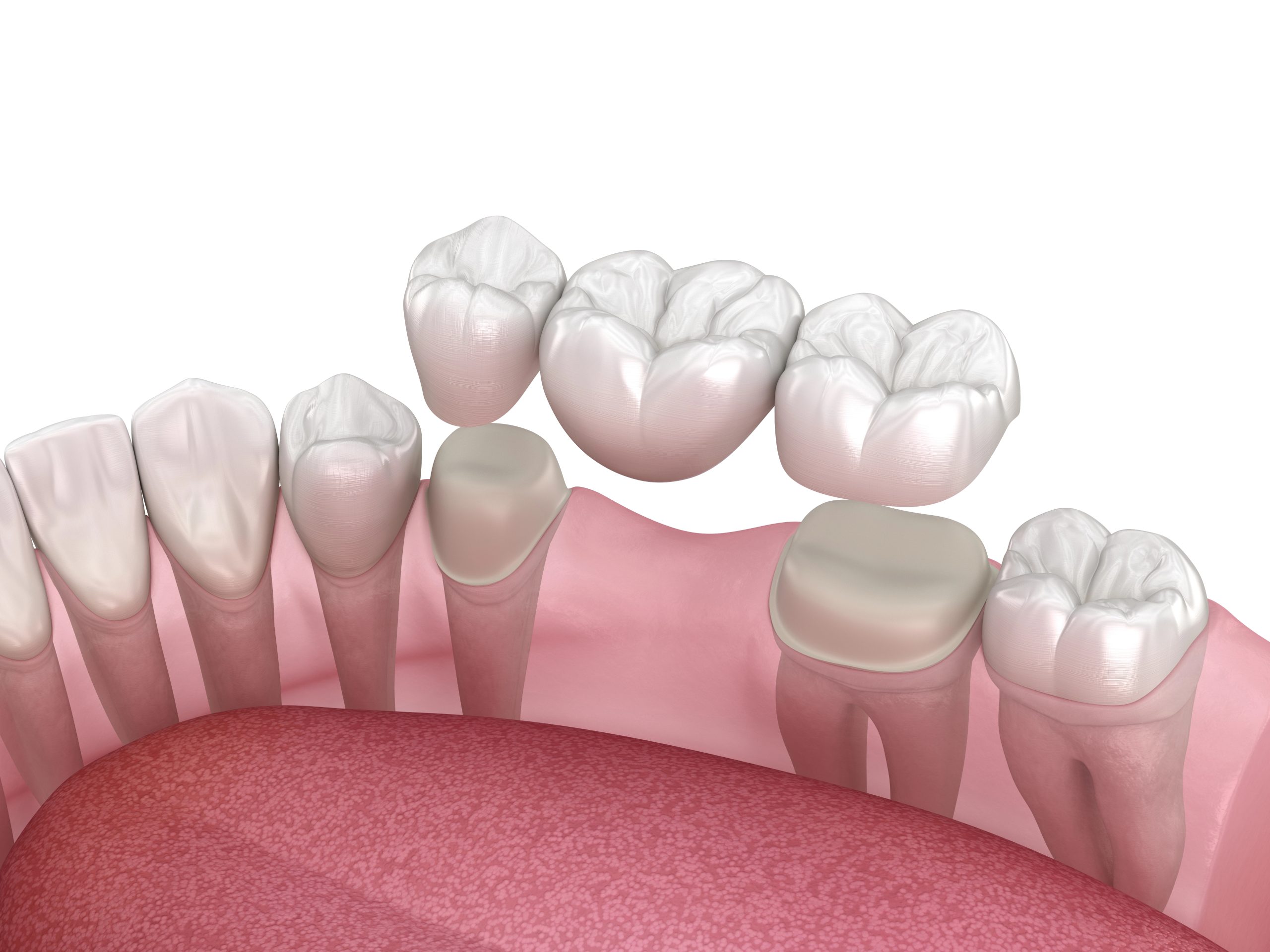 Are Dental Bridges the Right Solution for Your Missing Teeth? 5 Are Dental Bridges the Right Solution for Your Missing Teeth?